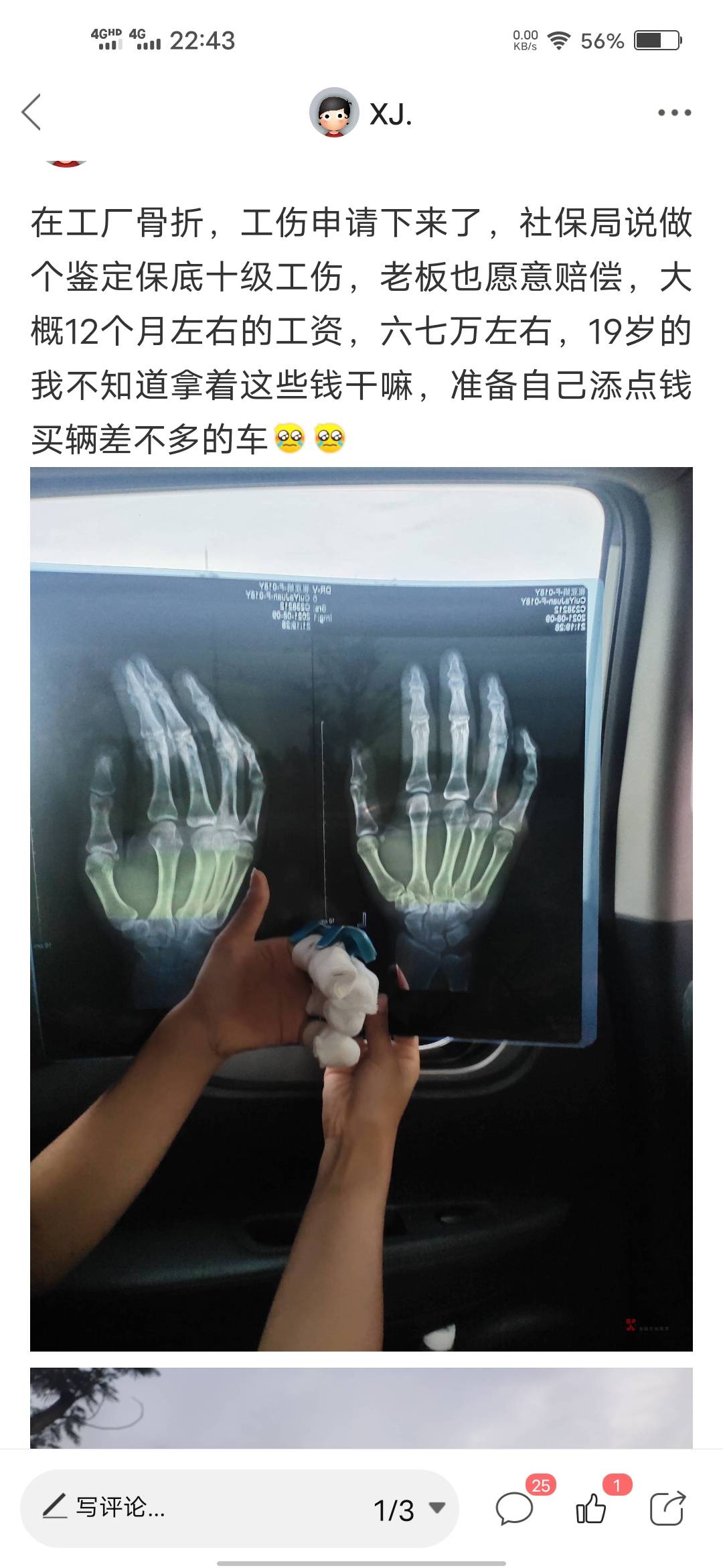 回想起去年，真的好难，在厂里手指头骨折了，每天自己一个从高埗跑到长安去社保局做鉴18 / 作者:XJ. / 