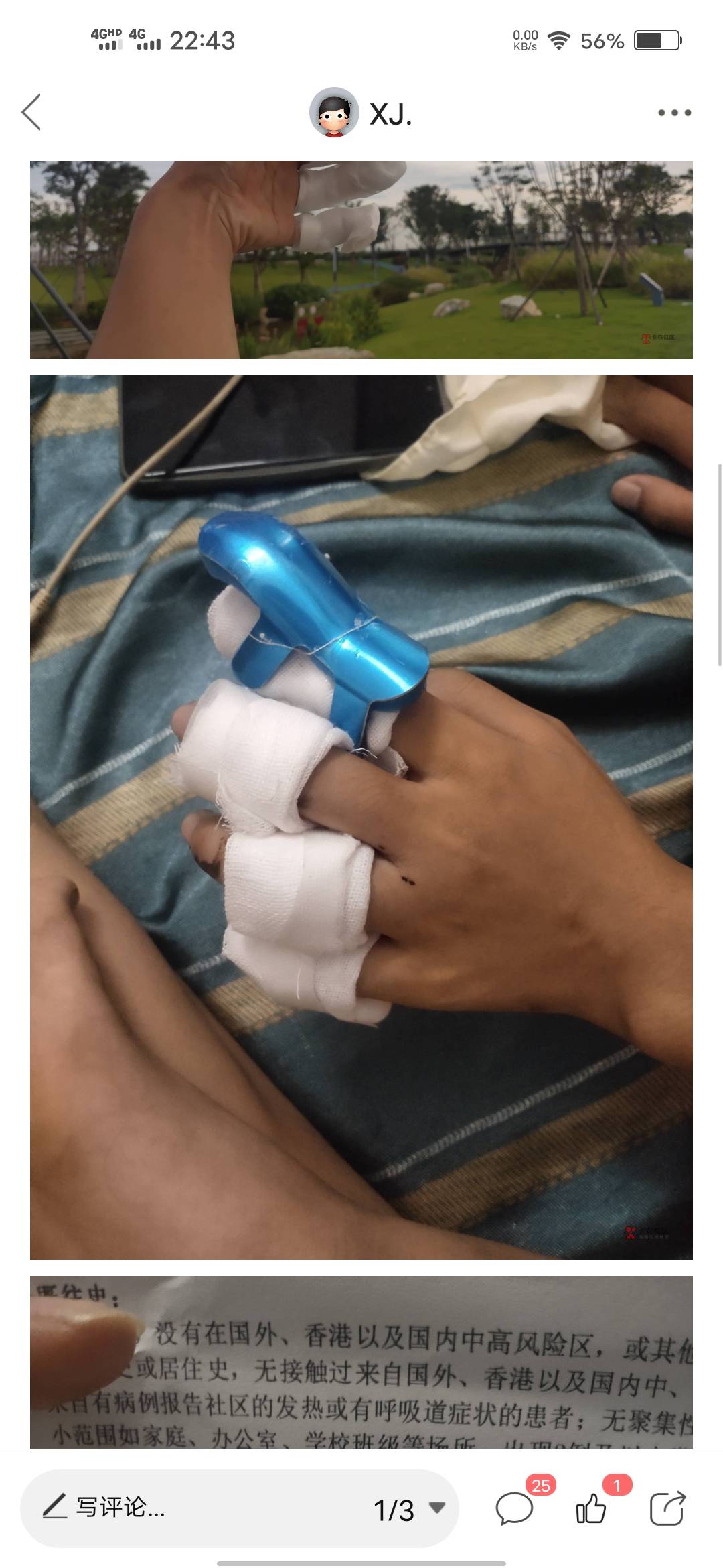 回想起去年，真的好难，在厂里手指头骨折了，每天自己一个从高埗跑到长安去社保局做鉴99 / 作者:XJ. / 