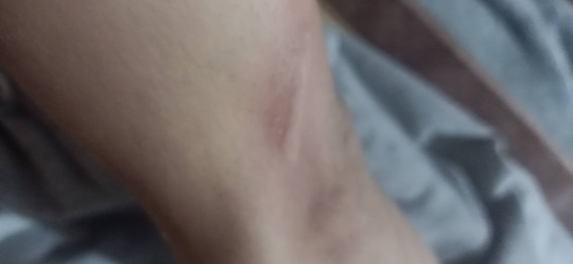 被自家猫挠了一下，破了一点点皮然后用清水清洗了一下，要不要去打针啊！！

83 / 作者:工作介绍 / 
