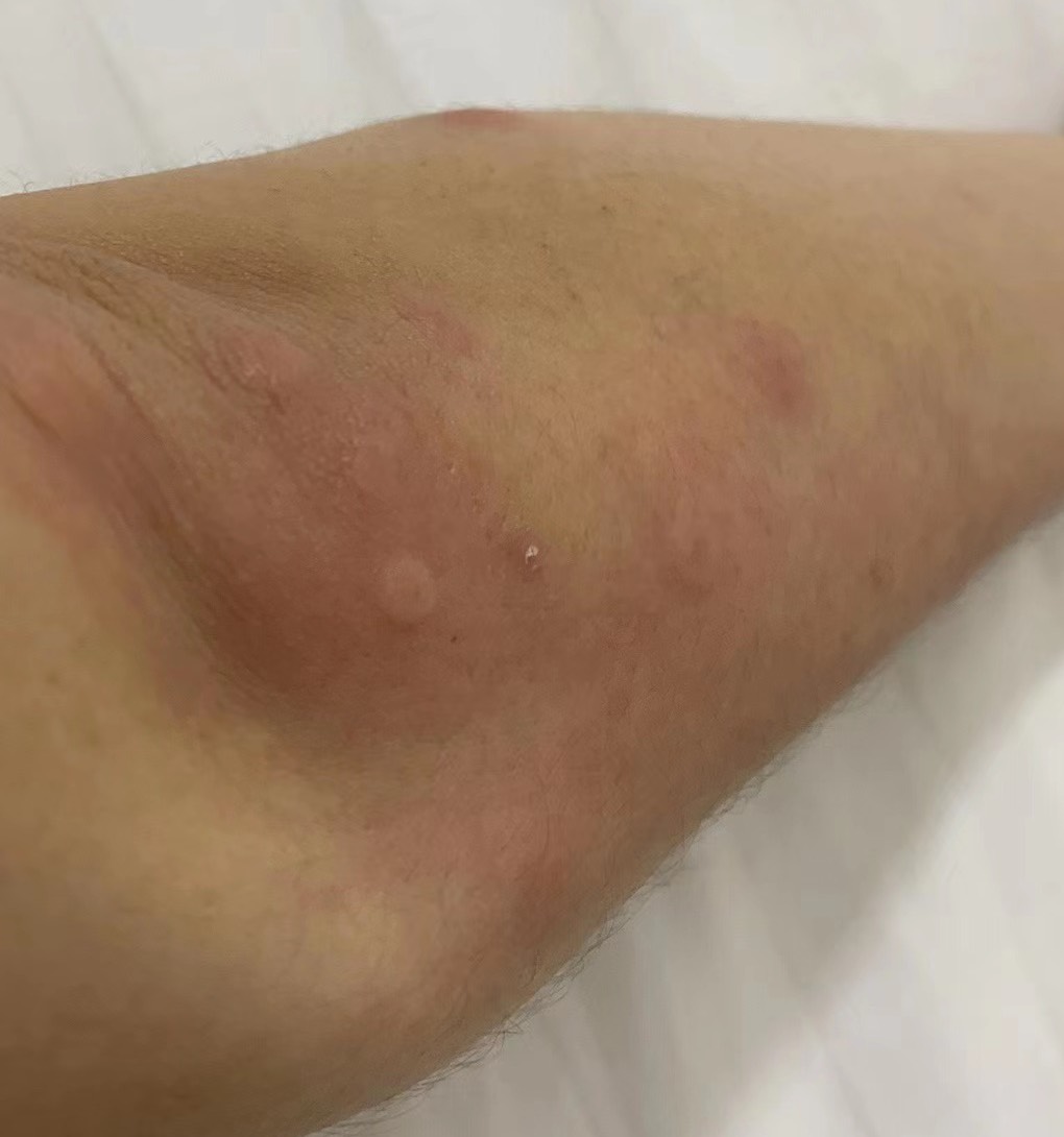 上个星期出去玩，住酒店两天长了一身包住了两天以为是蚊子咬的中间还跟老板说过两三次99 / 作者:大瑶锅 / 