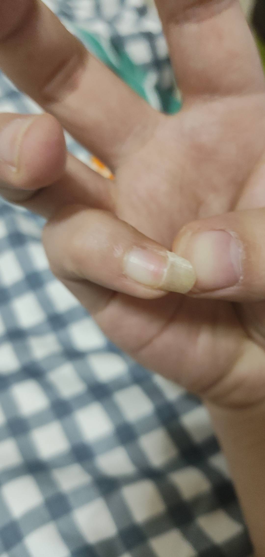 指甲自己脱落了，新陈代谢了吗

64 / 作者:吴小鸡 / 