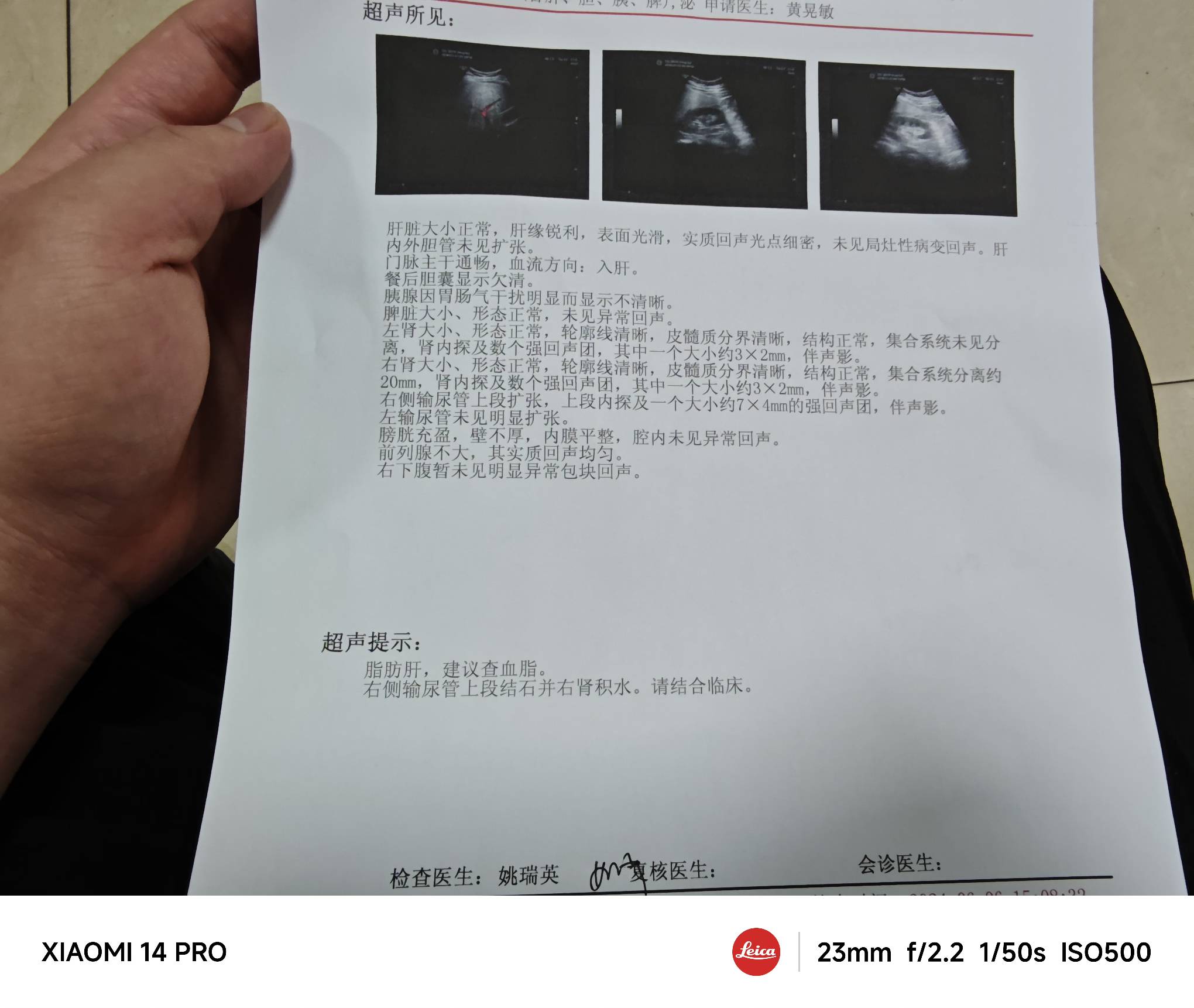 老哥们检查出来了输尿管结石 严重吗 

80 / 作者:　晟 / 