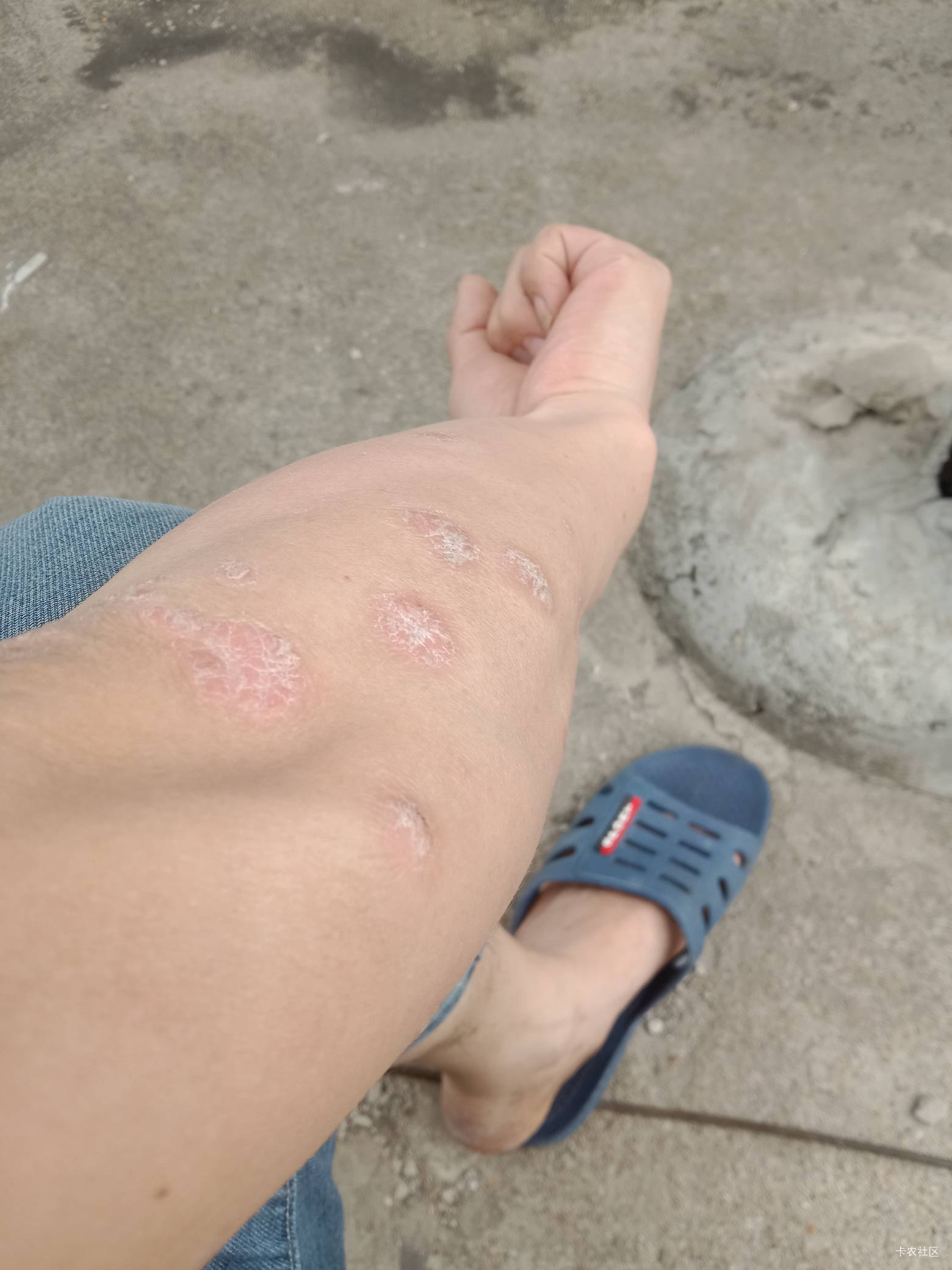 老哥们，身上起牛皮癣咋整。中药，西药吃遍了。不除根。因为这个好自卑，快45了，都不55 / 作者:mmmmkbh / 