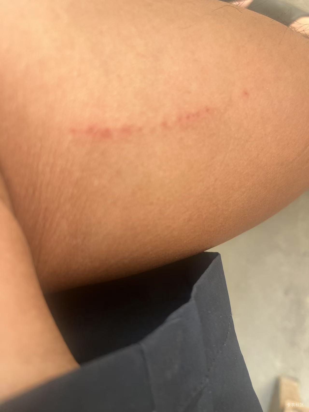 被小狗爪子抓的，它抱我腿的时候抓的，没事吧？

1 / 作者:我爱看动画片 / 