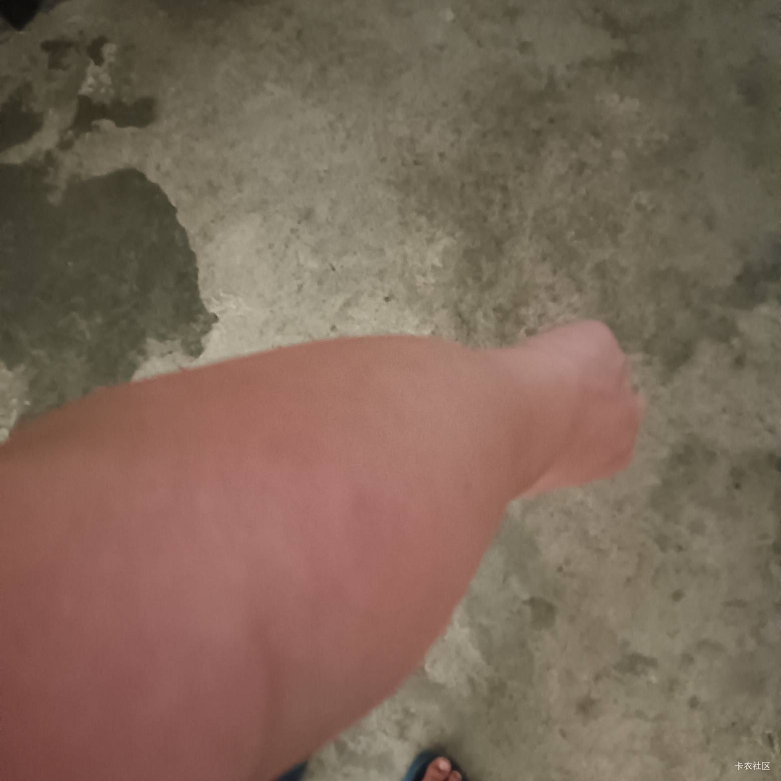 胳膊肿了这么大 胀得很


73 / 作者:那可不一定 / 