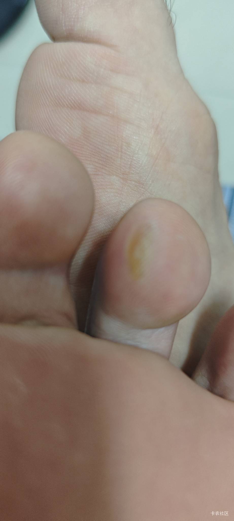 这二天搬家不停的上楼下楼.脚都起泡了.这种需要等它完全瘪下去才会好吗？


36 / 作者:卡农豆包 / 