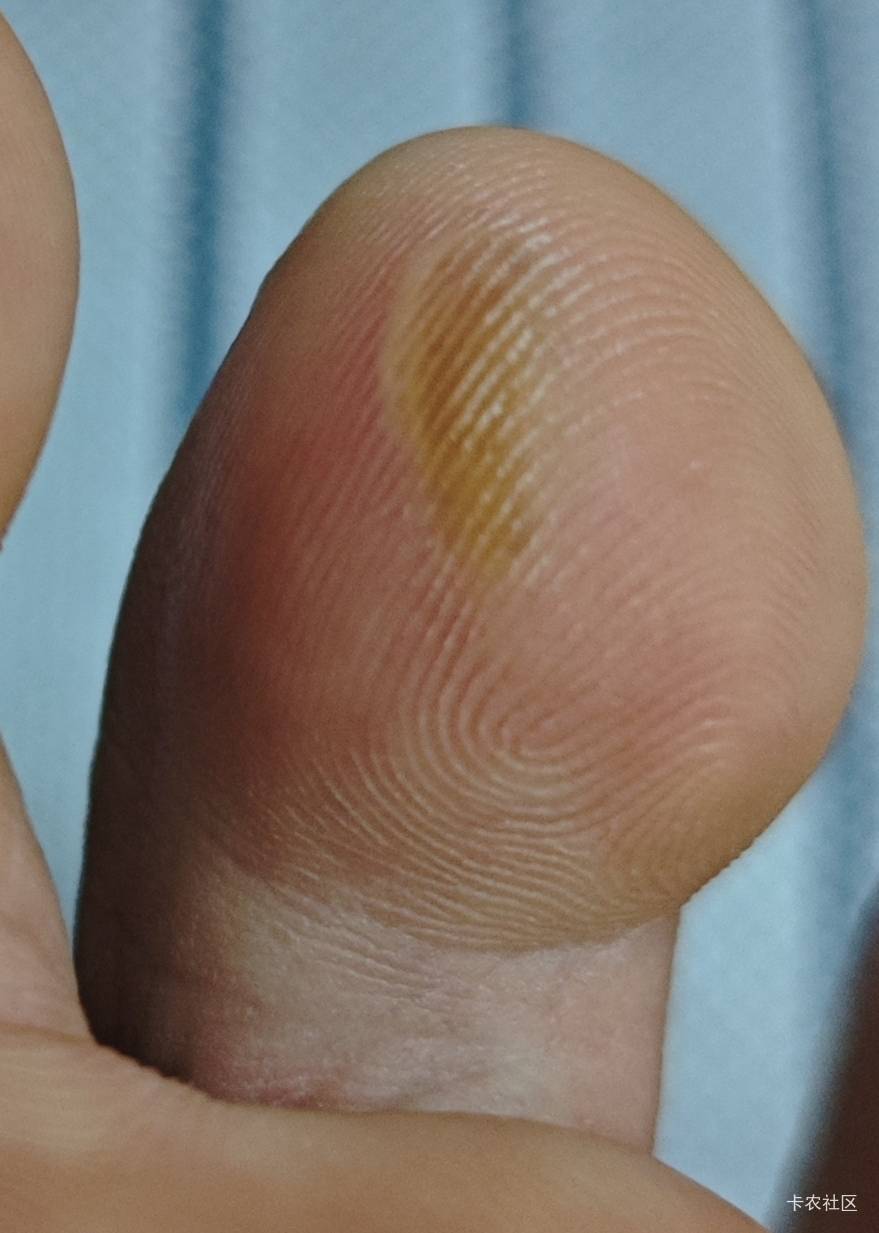 这二天搬家不停的上楼下楼.脚都起泡了.这种需要等它完全瘪下去才会好吗？


25 / 作者:卡农豆包 / 