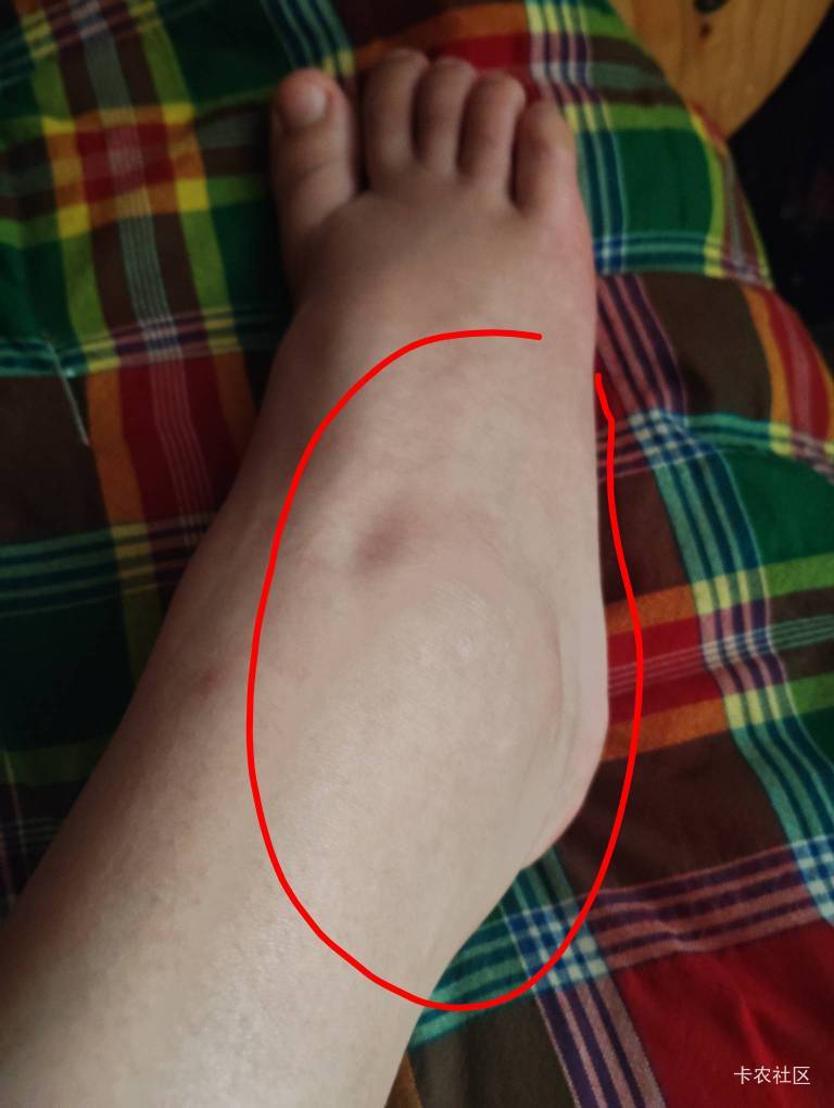 老哥们，你们知道这种症状是什么吗？
昨天早上一醒来右脚腕疼痛，肿胀，发热一动就痛65 / 作者:猴子乖宝宝 / 