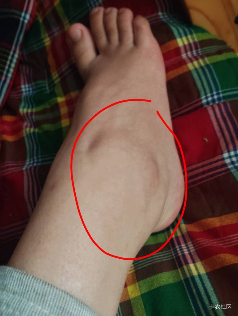 有谁知道这种症状是什么吗？
昨天早上一醒来右脚腕疼痛，肿胀，发热一动就痛，痛感会41 / 作者:猴子乖宝宝 / 