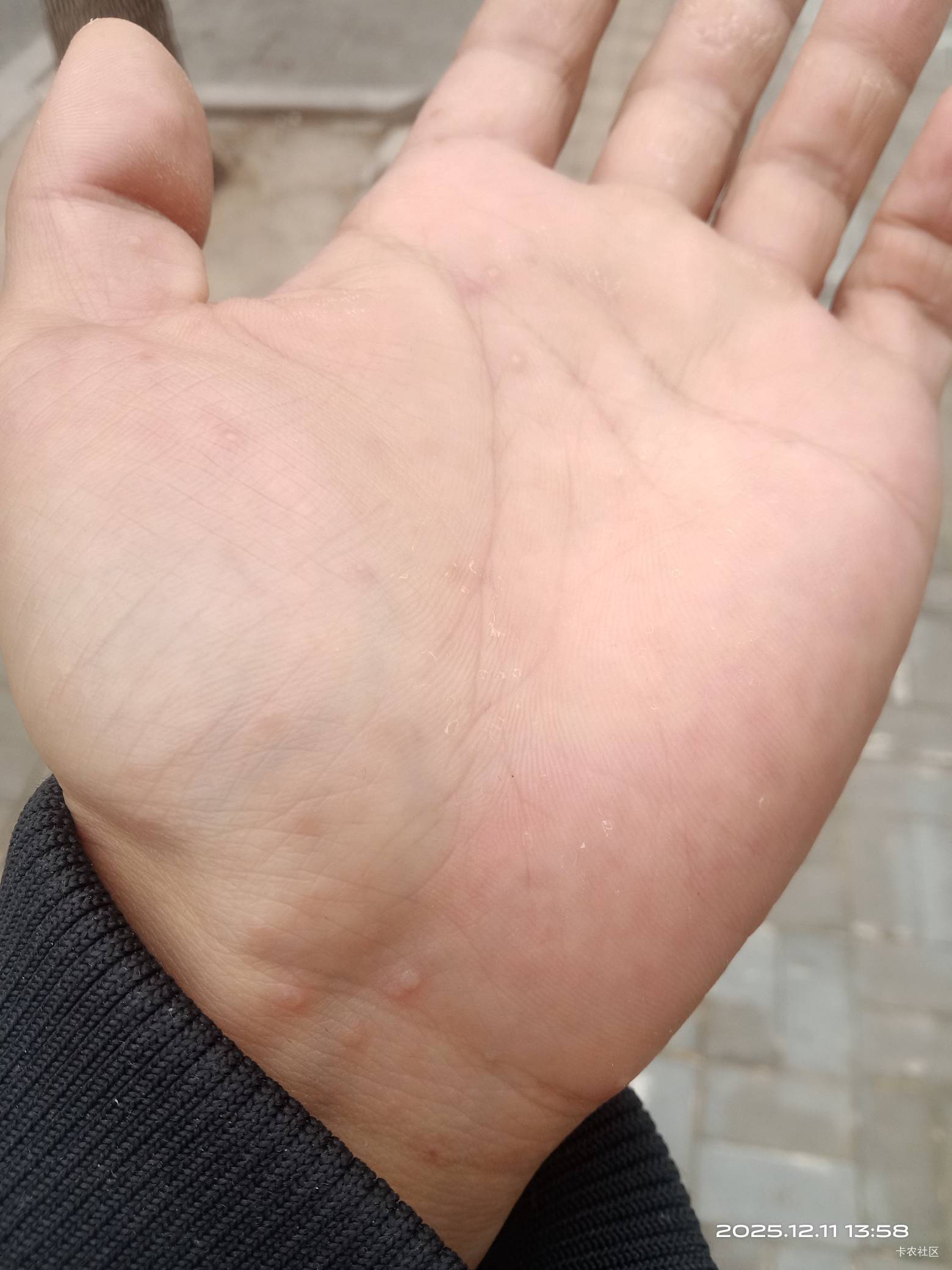 老哥们，手上为啥起了这么多小水泡。

93 / 作者:mmmmkbh / 