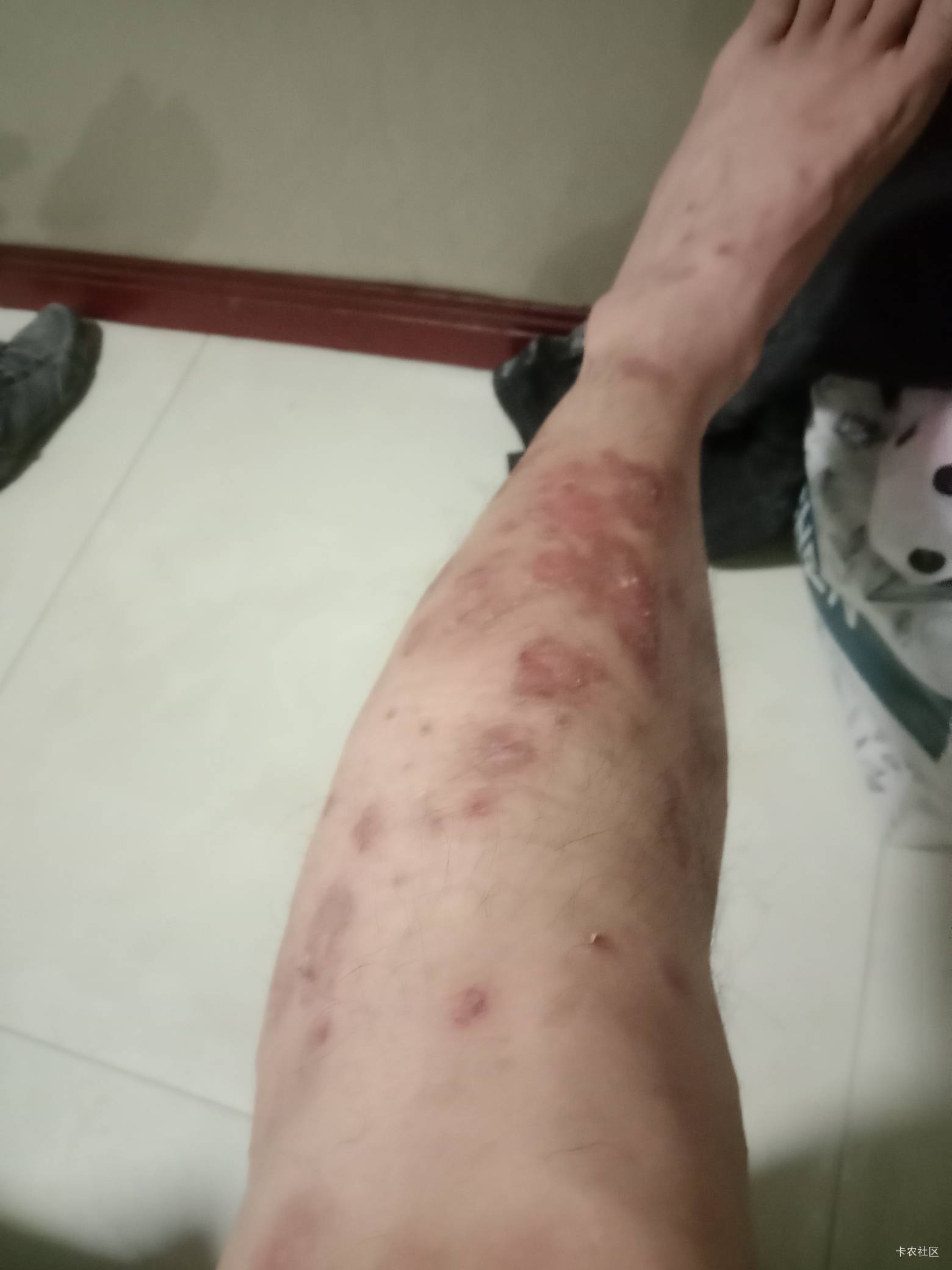 老哥们，我是不是快没了啊。感冒半个月一直不好。然后感冒之后身上就起这个东西。想去97 / 作者:mmmmkbh / 