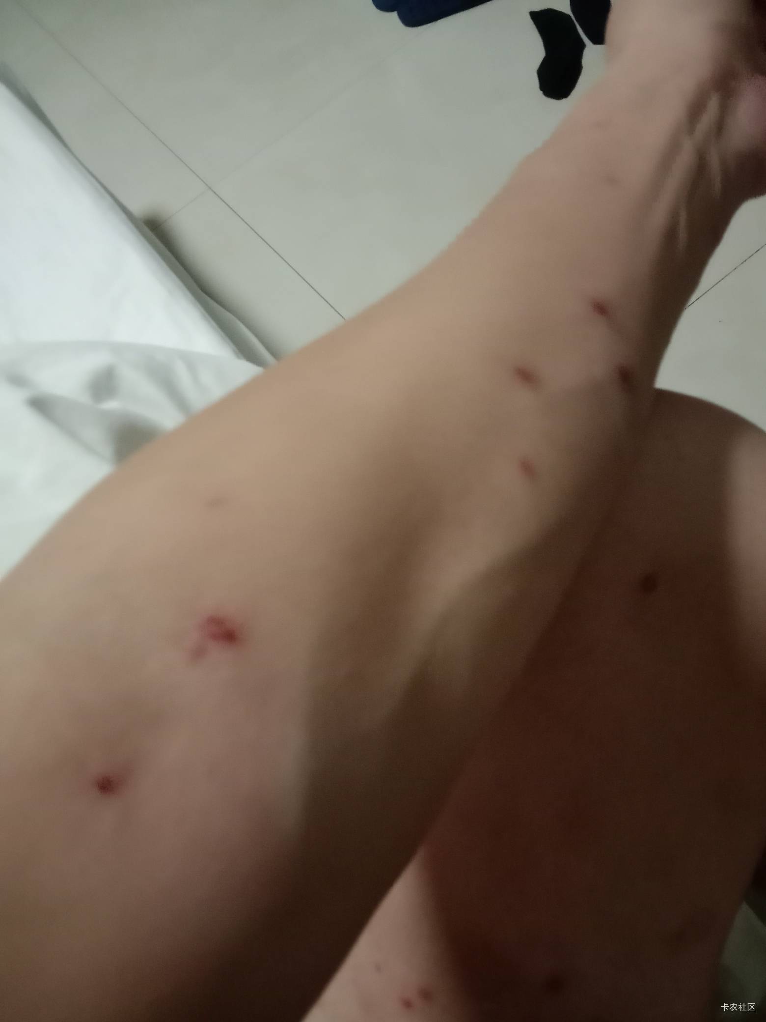 老哥们，我是不是快没了啊。感冒半个月一直不好。然后感冒之后身上就起这个东西。想去30 / 作者:mmmmkbh / 