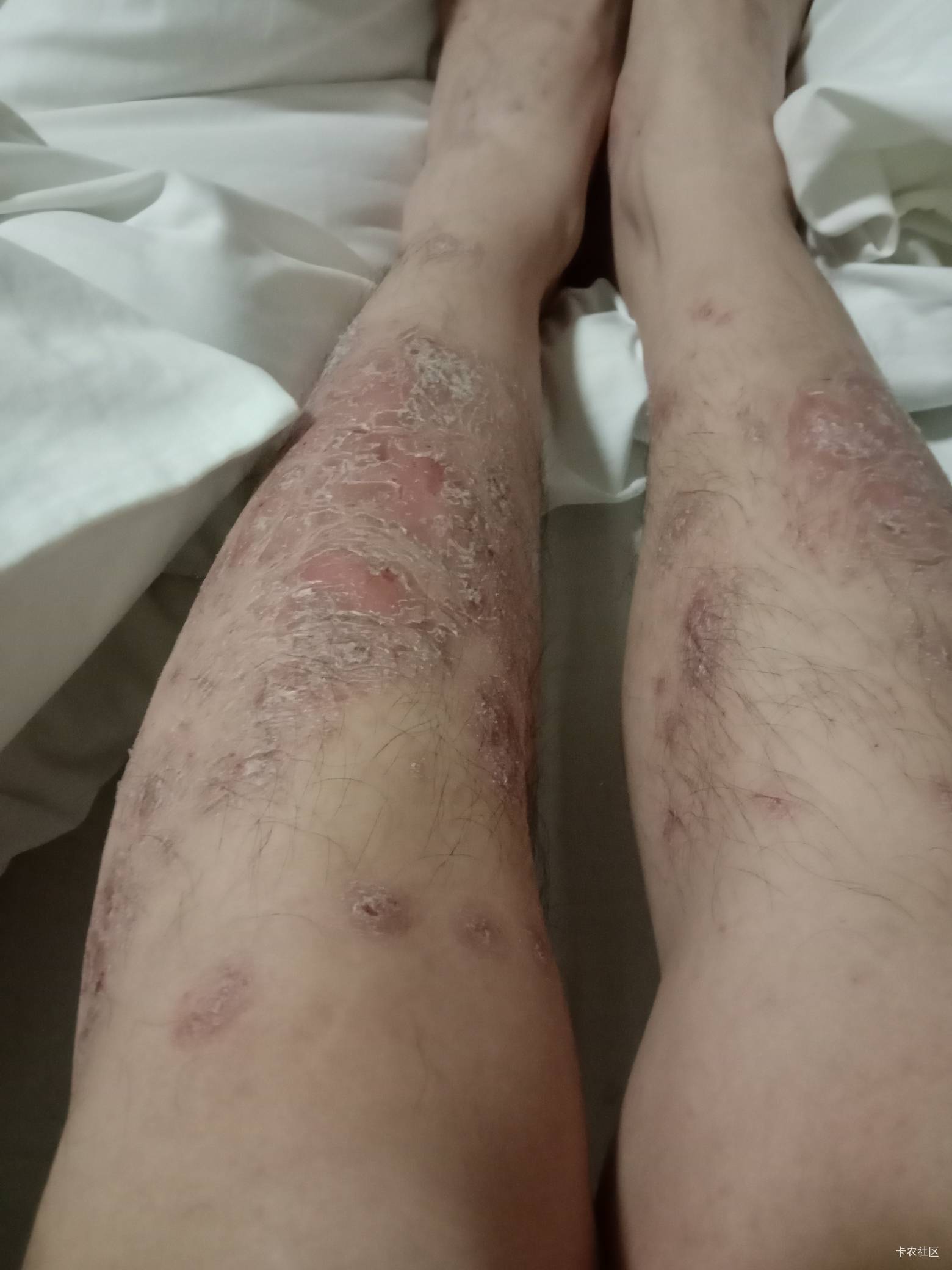 老哥们，一个星期前是这样。一个星期后成这样了，还流血，裂口子裂的疼


78 / 作者:mmmmkbh / 