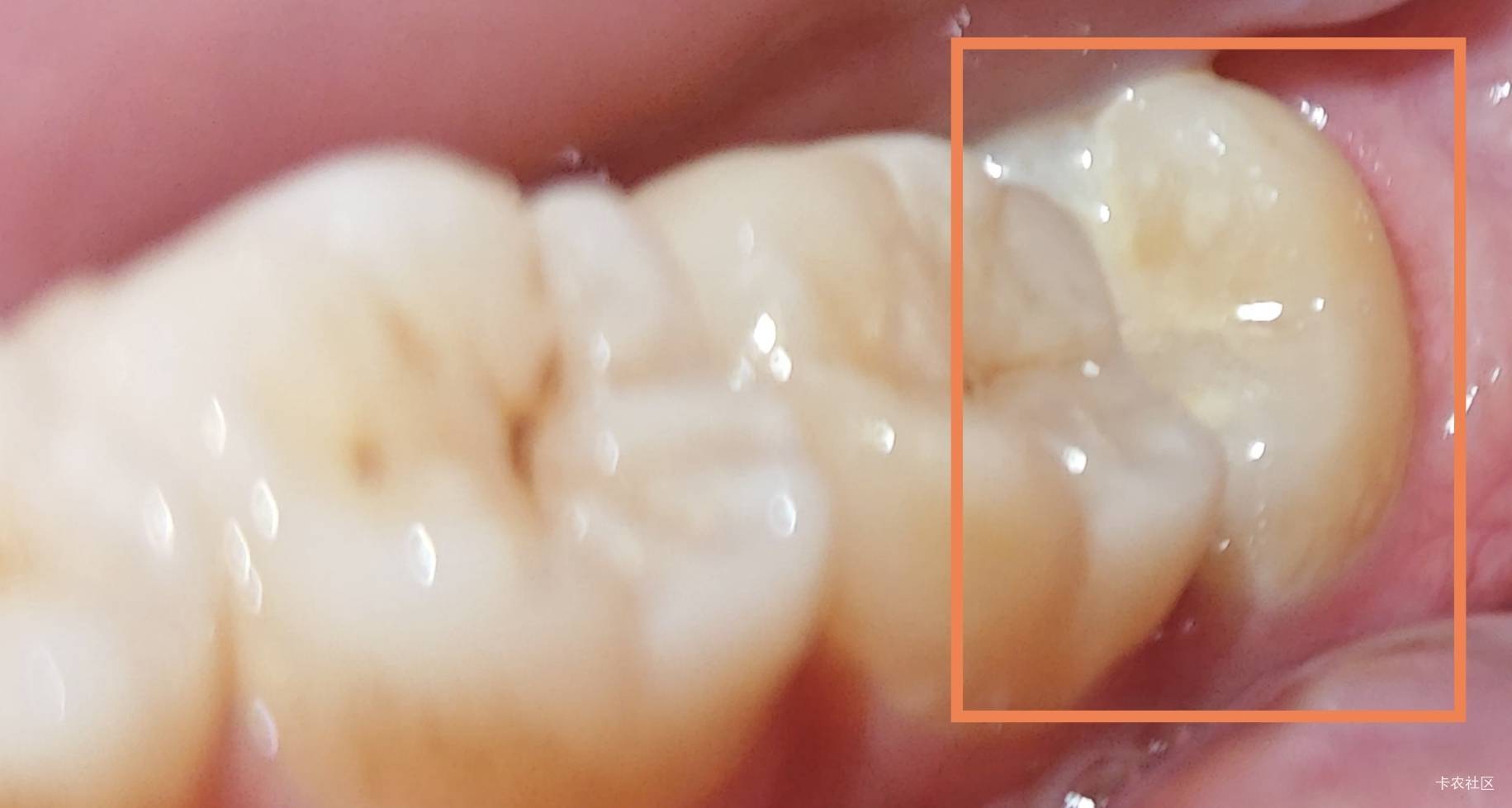 左下的这个智齿长的歪，几个月了，这两天才有点疼，应该是长完整了顶到我另一颗牙了，38 / 作者:暖风归去 / 