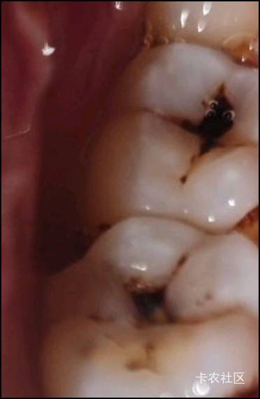 有一边有两个牙齿这样了，中间这么黑，另外一边就好好的

87 / 作者:羊肉汤 / 