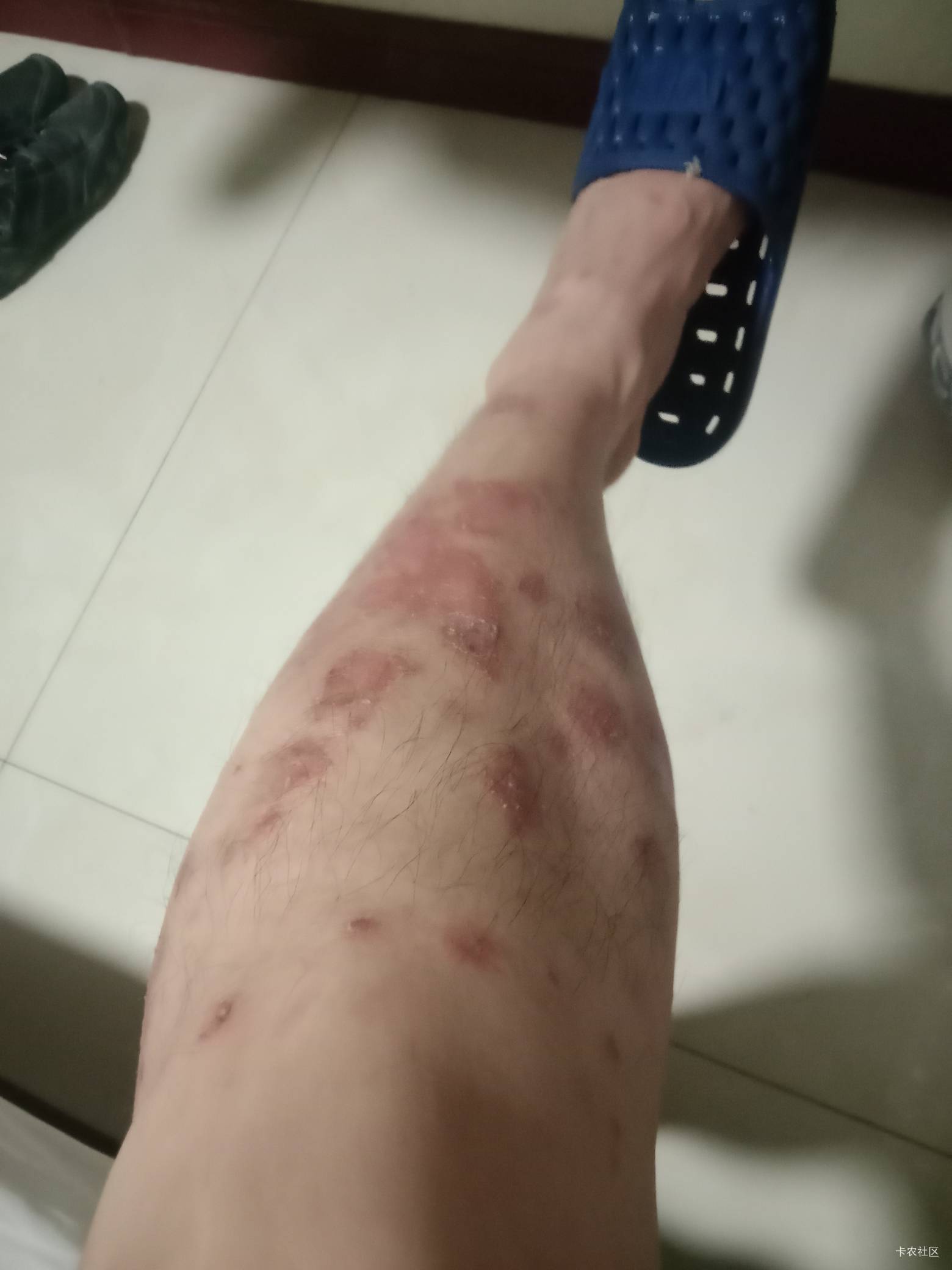 老哥们，从开始这样到后来这样，还流血。还疼。咋整啊。


32 / 作者:mmmmkbh / 