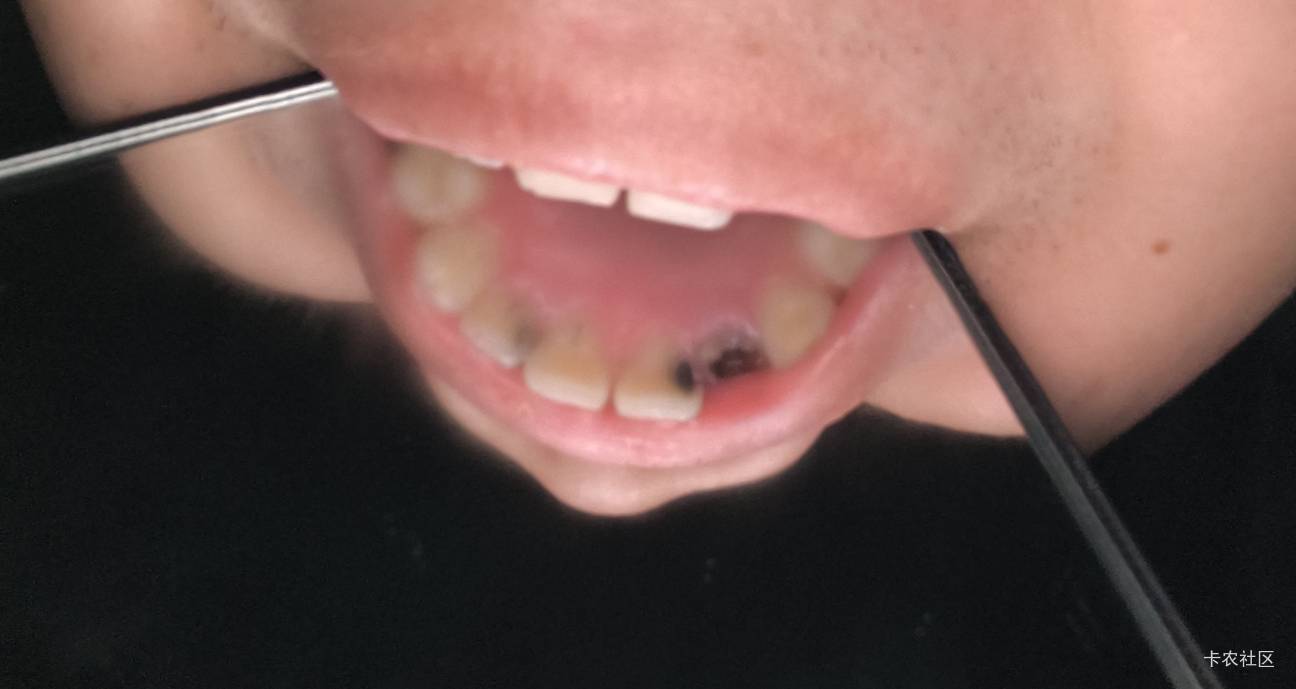 补那两个小半边的牙有那么便宜吗？听这些老哥说美团上面可以去补，就是这个没有烂到根69 / 作者:斗篷 / 