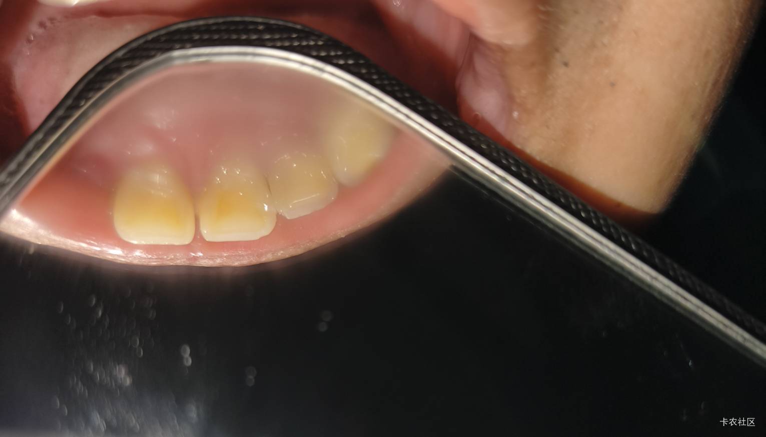 补牙真贵啊，现在用好一点的材质，380一颗的，补了4颗牙，花了1000多块钱。还有那几颗7 / 作者:斗篷 / 