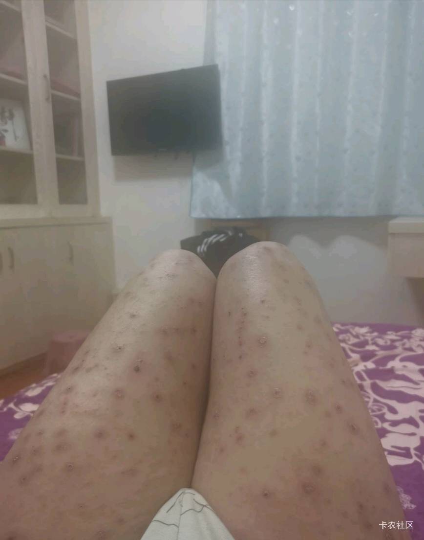 睡觉了老哥们  这腿是湿疹吗

43 / 作者:乌梅子 / 