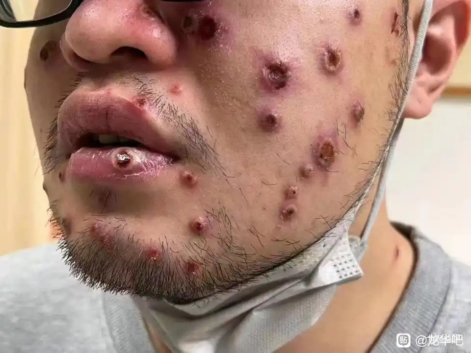 睡觉了老哥们  这腿是湿疹吗

4 / 作者:卡农菲菲菲 / 