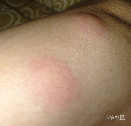 各位兄弟，可能有点不适，我今天住全季，身上突然就起来这个，我也不知道是不是蚊子咬17 / 作者:静观山水 / 