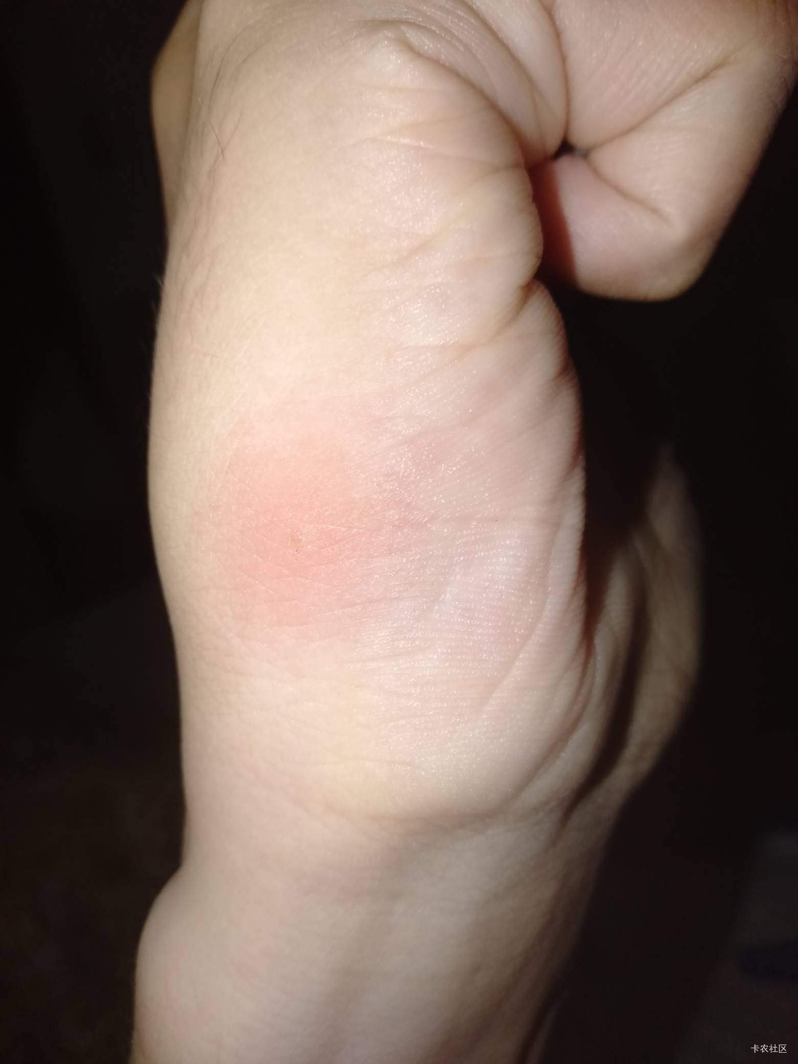 各位兄弟，可能有点不适，我今天住全季，身上突然就起来这个，我也不知道是不是蚊子咬3 / 作者:静观山水 / 