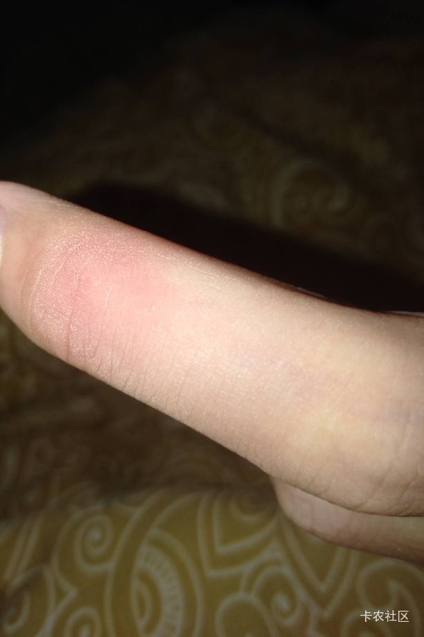 各位兄弟，可能有点不适，我今天住全季，身上突然就起来这个，我也不知道是不是蚊子咬54 / 作者:静观山水 / 