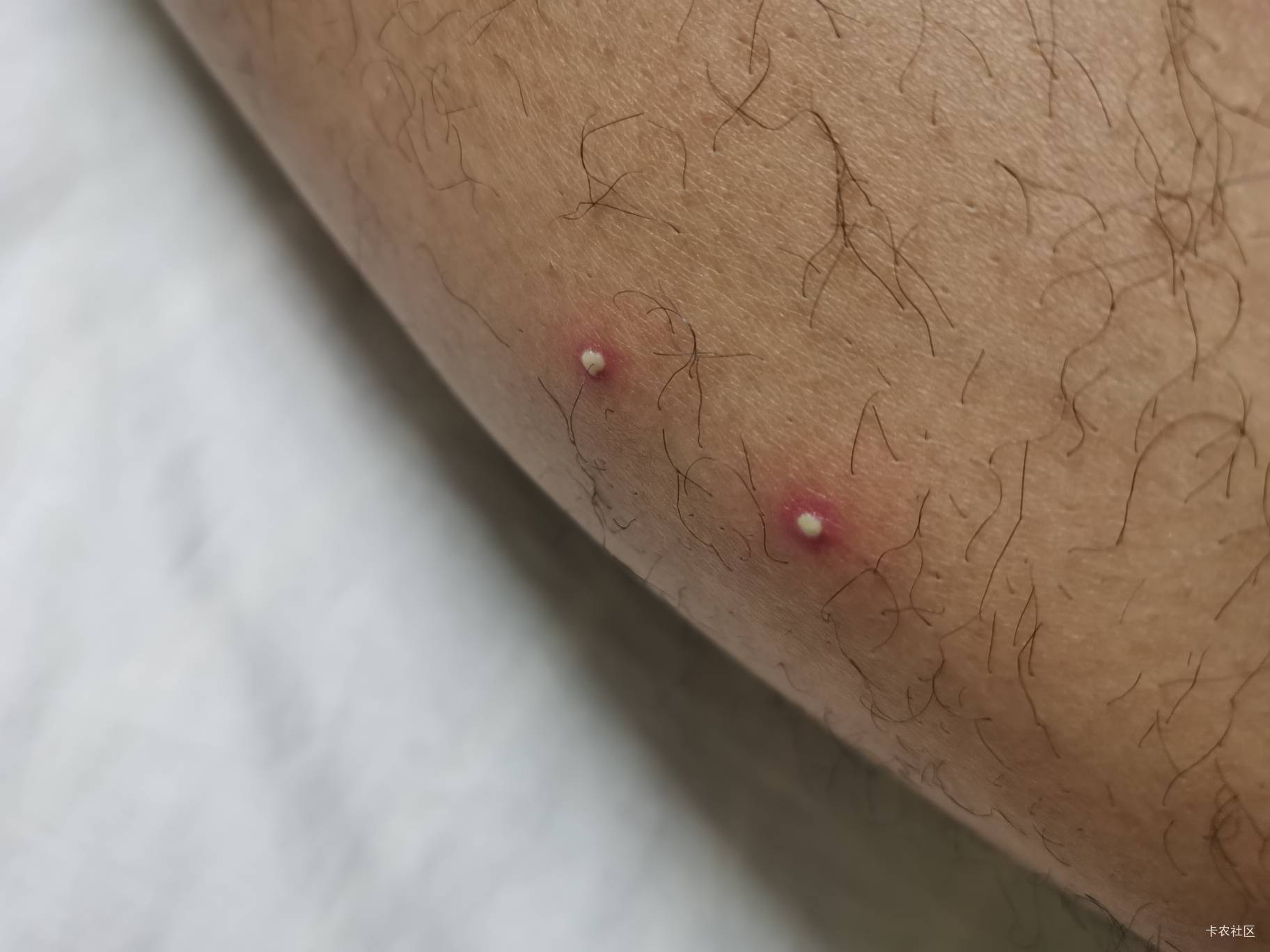 干活出汗就这样了 想挤但是不够大 摸着很解压这是毛囊炎吗小时候叫酒刺

52 / 作者:梦想当村长 / 