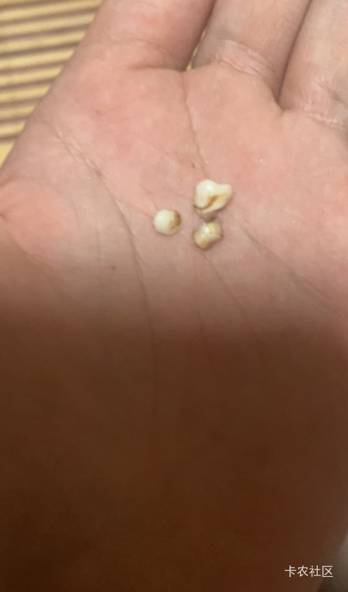 老哥们太难了，吃个花生米牙齿裂开，这是身体缺少什么元素

52 / 作者:卡农从不缺人才 / 